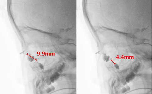 Figure 3 Methods for measuring the lengths of LS and bNLD. The long axes of both LS and bNLD were measured from the lateral view of the DCG. The images were converted to monochrome to facilitate the observation of contrast media.