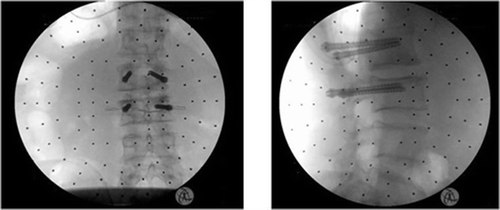 Figure 10. Anterior-posterior (a) and lateral (b) fluoroscopic views of SpineAssist-guided pedicle screw insertion (using the Hover-T clamping device).
