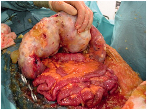 Figure 2. Intra-operative photograph with a massive omental cake. Note that the small bowel is free of disease.