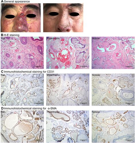 Figure 1 General appearance and pathological feature of PWS lesions.