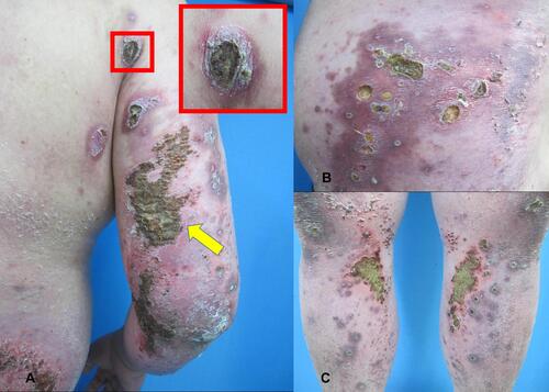 Figure 2 Clinical images of ARPC. (A) Koebner Phenomenon due to scratching can be seen at the elbow, and the lesions are fused into a piece (Yellow arrow). Typical rash for crater-shaped (White arrow); (B) crater-shaped rash of waist; (C) Koebner Phenomenon of lower limb.