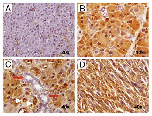 Figure 8 Inactivation of Brca2 promotes DNA damage in the exocrine pancreas. (A) Immunohistochemical staining for pH2AXSer139 shows minimal labeling within acinar cells in pancreatic tissue sections derived from hemizygous Pdx1-Cre; Brca2flox/wt mice (negativ function in CB mice results in markedly increased pH2AXSer139 immunolabeling in pancreatic acinar cells (B and C), but not in the ductal epithelia (red arrows). Note robust expression of pH2AXSer139 in two highly atypical acinar cell nuclei (white arrowheads). (D) Marked upregulation of pH2AXSer139 labeling in the sarcomatoid carcinoma component of a PDAC arising in a CBP mouse.