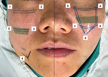 Figure 4 Patient’s right hemiface shows the reference adhesive for jowl fat compartment repositioning. The superior border of the adhesive sits at the level of the inferior orbital rim, the medial border at the level of the medial limbus and a distance of 5mm from the nasolabial fold, and the inferior end at the lowest point of the jowl (marked with methylene blue dye). Points 1 to 5 refer to entry and exit points of the needle in sequential order. Patient’s left hemiface shows reference adhesive for medial cheek fat compartment repositioning. The superior border of the adhesive sits at the level of the inferior orbital rim and the medial border at the level of the medial limbus and 5mm from the nasolabial fold. Points a to e refer to entry and exit points of the needle in sequential order.