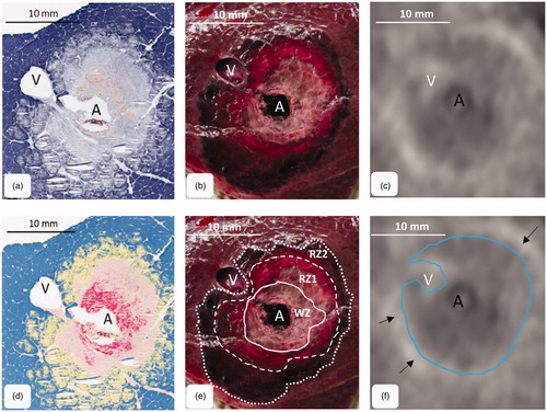Figure 2. MWA were cut orthogonally to the antenna through the center of the ablation. The figure shows the corresponding cross sections: (a) histology (NADH-staining), (b) macroscopy and (c) CECT-imaging. (d) A chromatic visualization of the histological cross sections was performed with an image analysis software in order to identify different ablation zones. (e) three different ablation zones could be identified macroscopically (mWZ, mRZ1 and mRZ2). (f) A single MWA zone could be identified around the antenna (tissue with lower density compared to native liver tissue). A small hyperdense margin was seen around the ablations (arrows). A: antenna; V: hepatic vein.