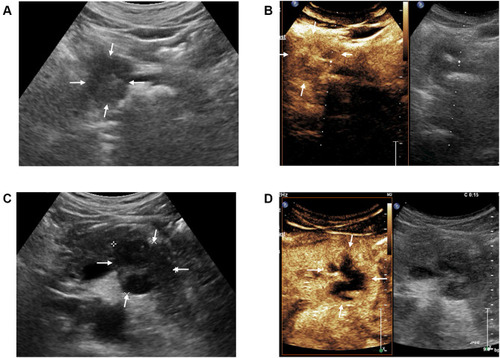 Figure 2 CEUS enhancement patterns in the arterial phase in PDAC. (A and B): A 53-year-old male patient with PDAC located in the head of the pancreas. Rapid iso-enhancement was observed in the arterial phase of CEUS (18 s) (as shown by the white arrows). (C and D): A 42 year-old male patient with PDAC located in the  body of the pancreas. Hypo-enhancement was observed in the arterial phase of CEUS (15 s), and no areas of enhancement were visible within the tumour (as shown by the white arrows).