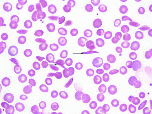 Figure 1.  Peripheral blood smear depicts a reversible (R) sickled cell and two irreversible cells (arrows). There is anisocytosis and target cells.