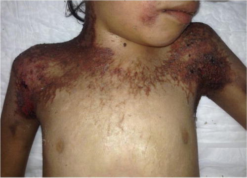 Fig. 2 Cutaneous manifestations of pellagra. Symmetrical and bilateral hyperkeratotic skin in a parchment like appearance affecting neck and thorax. There are erosions and blackish crusts resulting from hemorrhages.