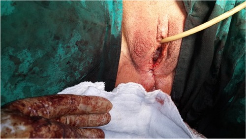 Figure 3 The same patient of Figure 1 after the vaginal introital epithelium was approximated with an absorbable running suture, leaving the resultant genital hiatus of about 1 cm in length.