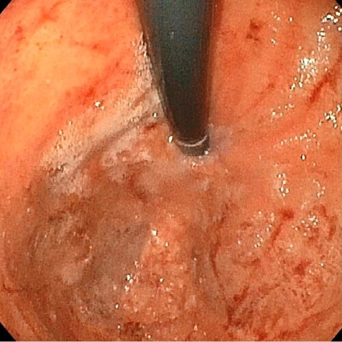 Figure 7. Endoscopy demonstrated superficial erosions, erythema, and edema of the cardia/fundus after ingestion of ∼30ml of 35% hydrogen peroxide.