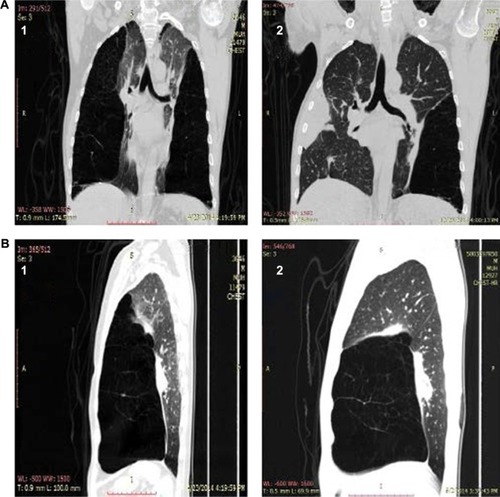 Figure 4 HRCT with coronal reconstruction (A) and sagittal reconstruction (B) in patient who underwent BLVR with fibrin glue.