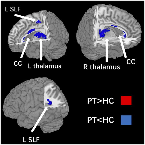 Figure 2. Four clusters with decreased FA were identified in PT compared with HC: the corpus callosm, bilateral thalamus and the left superior longitudinal fasciculus II. FA, fractional anisotropy; PT, preterm; HC, healthy control. CC, corpus callosm; L, left; R, right; SLF, superior longitudinal fasciculus.