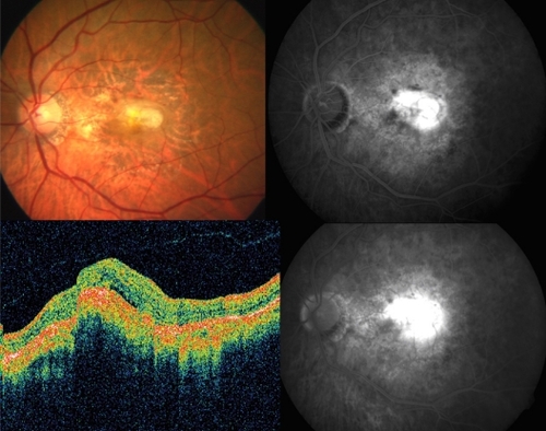 Figure 4 Case 3: Color fundus photograph of the left eye (upper left) shows a partially regressed choroidal neovascularization. Early hyperfluoresence with intense late staining on fundus fluorescein angiography confirms the presence of choroidal neovascularization (upper right and lower right). Optical coherence tomography scan reveals the presence of subfoveal fluid and cystoid macular edema associated with the choroidal neovascularization (lower left) in the left eye.