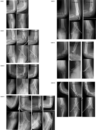 Figure 1. The primary radiographs (anterior-posterior and lateral projection) of all flexion-type supracondylar humerus fractures (cases I–VII) during the 10 years of the study period (2000–2009). Postoperative radiographs and the radiographs at the last short-term follow-up visit are also presented.