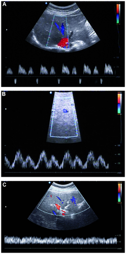 Figure 1 Duplex Doppler sonography of the right hepatic vein in a healthy control subject shows triphasic waveform. Two antegrade peaks are separated by a short phase of retrograde flow (A). Duplex Doppler sonography of the right hepatic vein in a subject with moderate hepatosteatosis shows biphasic waveform without reversed flow (B). Duplex Doppler sonography of the right hepatic vein in a subject with severe hepatosteatosis shows monophasic waveform with continuous flat flow (C).