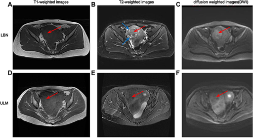 Figure 6 (A–C) Leiomyoma with bizarre nuclei (LBN) in a 47-year-old woman. (A) Axial MRI in a T1-weighted image shows the mass is isointense to hypointense compared with adjacent normal outer myometrium (red arrow). (B) T2-weighted fat-saturated image shows heterogeneous (red arrow) and lace-like (blue arrows) hyperintensities in the mass. (C) Axial b800 diffusion weighted image (DWI) demonstrated mild-restricted diffusion of solid components (red arrow). (D–F) Leiomyoma with usual-type leiomyoma (ULM) in a 48-year-old woman. (D) Axial MRI in a T1-weighted image shows the mass is isointense to muscle (red arrow). (E) T2-weighted fat-saturated image shows homogeneously hypointense in the mass (red arrow). (F) Axial b800 DWI demonstrated unrestricted diffusion of solid components (red arrow).