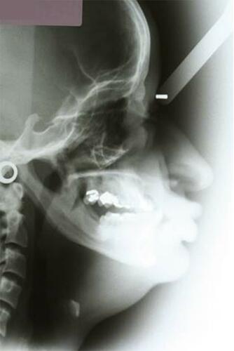 Figure 4 Initial lateral cephalogram.