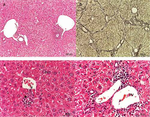 Figure 6. Photomicrograph of sections of liver of HCC mice treated with MET (25 mg/kg) showing slightly altered architecture. (a, c & d) stained with Hx & E. (b) stained with silver nitrate. (a) shows slightly altered architecture, (b) shows mild fibrosis, (c) shows polygonal hepatocytes with centrally located nuclei (n) with different sizes, apoptotic cell (arrow), and inflammatory cells were noticed near the central vein (asterisks), and (d) shows the histological structure of the portal area.