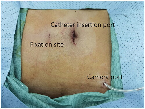 Figure 4. Port placements.