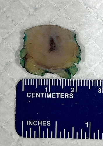 Figure 1 Pathologic macroscopic image of the tumor surgically excised. Measuring 1.7×1.2 x 1.2 cm.