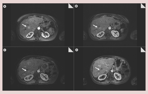 Figure 1.  Magnetic resonance imaging images of VIPoma lesions at different moments of the disease.(A) Basal. (B) 6 months after selective internal radiation therapy. (C) 12 months after selective internal radiation therapy. (D) 2 years after selective internal radiation therapy. A ring enhancement can be observed in the tumor, secondary to a decrease in intralesional vascularity.