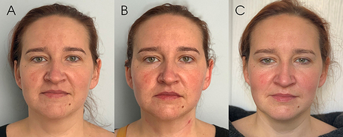 Figure 4 40-years old patient pictures, taken: (A) Before the injection procedure, (B) Immediately after, (C) After 3 weeks.