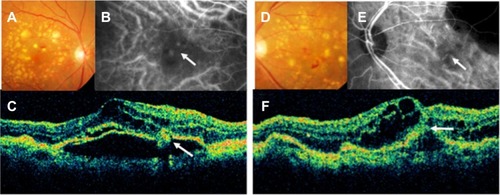 Figure 1 Color fundus photographs (A and D), indocyanine green fundus angiographies (B and E), and optical coherence tomography images (C and F) from the right eye (A–C) and the left eye (D–F) of an 83-year-old woman (patient 1).