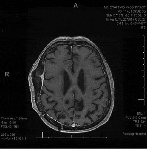 Figure 3. No evidence of an enhancing intracranial mass. Stable focal meningeal thickening along the right lateral frontal temporal lobe