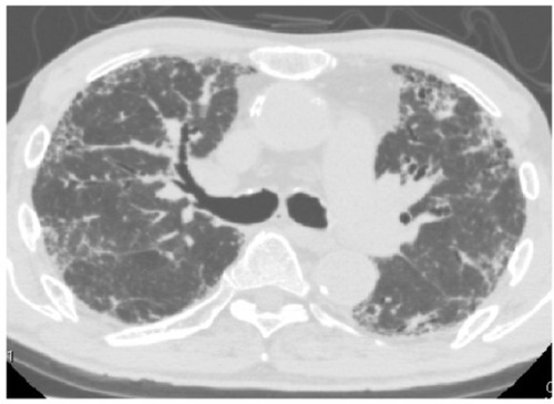 Figure 3 Chest computed tomography scan obtained at the 10-month follow-up visit.