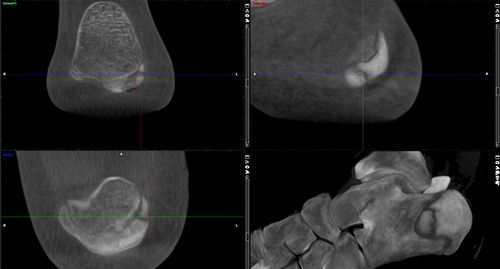 Figure 2 Weight-bearing cone beam CT (WBCT, SCS Med Series H22, 748mGy x cm2) showing a non-healed epiphyseal fracture of the calcaneus eight weeks after a landing in Parkour.