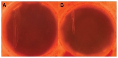 Figure 1 Photos of the left (A) and right (B) corneas in Optisol GS medium, showing detached, scrolled Descemet’s membrane in the periphery.