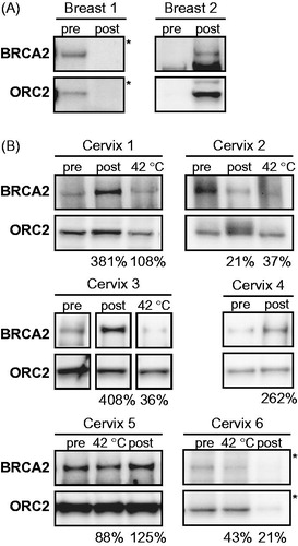 Figure 4. BRCA2 protein levels in biopsies taken before and after hyperthermia treatment in vivo. Immunoblots of biopsies taken before (pre) and after (post) hyperthermia in (A) breast tumours and in (B) cervical tumours. Samples marked with “42 °C” received ex vivo hyperthermia as an internal control. Shown are BRCA2 and ORC2. The percentages at the bottom of each panel indicate the relative intensity of the BRCA2 signal (corrected to ORC2) in the heat-treated sample compared to the non-treated sample. *For clarity of presentation the shadow values were reset from 0 to 175 in Adobe Photoshop.