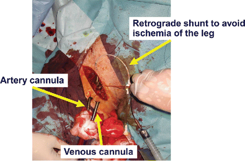 Figure 3. Example of insertion of ECPR by nonsurgeon.