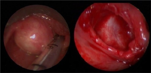 Figure 2 The cyst before and after excision in case 2.