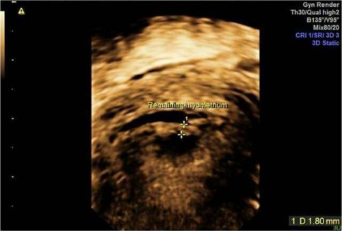 Figure 3 Residual myometrial tissue assessment by 3D ultrasound in no cervical dilatation group.