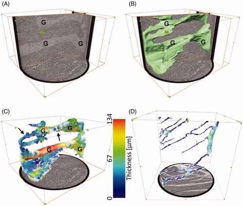 Figure 8. Qualitative and quantitative analysis of the neural tissue volumetric structure in the overview scans. (A) Arbitrary slicing planes allow to follow the network of ganglia (G) and interconnecting nerve bundles in the healthy colon sample (overview scan performed with the liquid metal jet setup). (B) A volume rendering of the segmented neural tissue (in green)helps to visualize the 3D network and study its shape. (C) Spheres (color-coded based on their diameter) are fitted in the volumes to approximate the thickness of the structure in each point. (D) Thickness estimation applied to the ileum sample from a patient affected by Ehlers-Danlos syndrome and gastrointestinal dysmotility(overview scan performed with the rotating anode setup). The color scale is the same as in C, for comparison purposes. G: ganglia; arrows: interganglional nerve fascicles. In A, B and C, the box surrounding the sample measures approximately 1050 x 1050 x 700 µm3. In D, the box measures approximately 1100 x 1100 x 1100 µm3, as the extracted biopsy punch was taller. A video clip illustrating these concepts in the healthy colon sample is provided as Supplemental Material (Video 2).