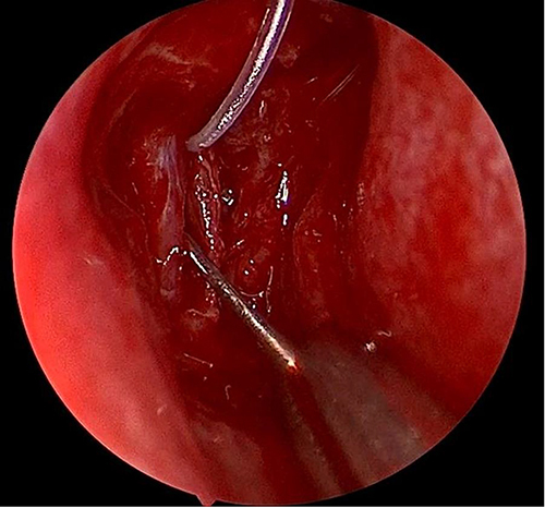 Figure 3 Insertion of eagle tube under vision after opening of lacrimal sac in endoscopic DCR.