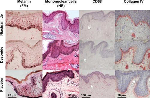 Figure 4 Reduction of epidermal melanin content (Fontana-Masson staining, 400×) after niacinamide and desonide, compared with placebo (first row).