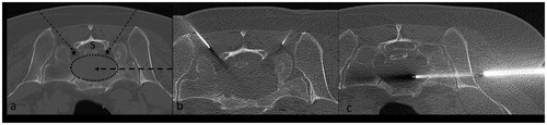 Figure 6. (a) Axial CT image of an osteolytic metastasis (dotted ellipse) in the sacrum. In this case, considering the deep location of the lesion in relation to the sacral canal (S) and sacral foramina (stars), there is no suitable access for the US beam (group (c)). (b, c) CT-scan images showing ablation of the lesion. Manual instillation of 0.9% normal saline in the sacral foramina was performed for thermo-protection (b). The ablative probe was inserted coaxially in a 14-gauge penetration set, introduced laterally into the lesion.