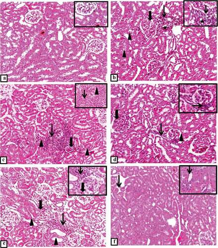 Figure 2. (a-f) Representative photomicrograph of the kidney from different experimental groups. a) control group shows normal histological appearance of renal parenchyma with normal glomerulus and tubules. Inset demonstrates normal histological appearance of renal tubules. b) T2DM group shows mild glomerular mesangial thickening (thick arrow) with periglomerular aggregation of cellular infiltrates (thin arrow), some tubules appear vacuolated (arrowheads), atrophied necrotic tubules (star). Inset illustrates numerous lymphocytes (thin arrow) surrounding a necrotic tubule with pyknotic nucleus (star). c) T2DM + thyroidectomy group shows multifocal expanded and atrophied glomerulus (thick arrow) with tubular hyalinization, degeneration and necrosis (arrowheads) beside massive interstitial inflammatory aggregates (thin arrow). Inset demonstrates thickened bowman’s capsule (arrowhead) with hyalinized and thickened glomerular capillaries, reduction of uriniferous space and extensive interstitial aggregation of numerous macrophages (thin arrow). d) T2DM + thyroidectomy group demonstrates glomerular mesangial expansion (thick arrow), periglomerular inflammation with interstitial fibrosis (thin arrow) and tubular degeneration (arrowhead). Inset at higher magnification shows periglomerular sclerosis (thin arrow). e) operative sham group shows glomerular expansion (thick arrow) with minimal uriniferous space and interstitial inflammation admixed with few fibroblasts (thin arrow) surrounding a necrotic and ectatic tubules (arrowheads). Inset illustrates mesangial expansion (thickarrow) with periglomerular aggregations of lymphocytes, macrophages and fibroblasts (thin arrow). f) T2DM + thyroidectomy + L-thyroxine group demonstrates restoration of most renal architecture with occasional interstitial inflammation (thin arrow). Inset shows few ectatic tubules (thin arrow). Image magnification = 100×, inset = 400×.