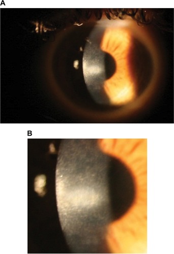 Figure 3 (A and B) Left eye 4 months post-op showing central corneal opacity with dense central vertical striae.