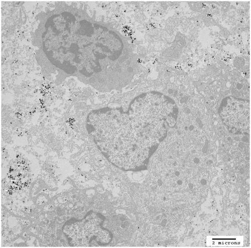 Figure 1. TEM image of mNP associated with murine mammary adenocarcinoma (MTGB) tumour cells. This section was acquired 5 min following delivery of 7.5 mg Fe/cm3 directly into the MTGB tumour mass. mNP (black specs) are located between cells (interstitial space), attached to the exterior aspect of the cell plasma membrane or in membrane associated vesicles. Scale bar = 2 μm. Qualitative evaluation of tumours (n = 4), harvested at the prescribed treatment time, indicate that the mNP distribution at the initiation of AMF is dominated by extracellular mNP.