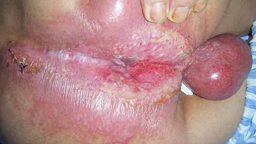 Figure 1 Ulcers around the anus extending to scrotum.