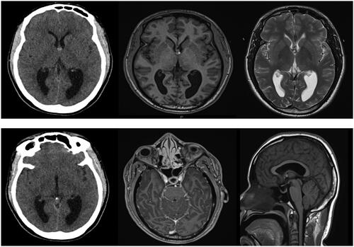 Figure 1. (a) plain axial CT demonstrating a hyper dense lesion consistent to a colloid cyst and some acute hydrocephalus evidenced by bilateral frontal horn dilation and temporal ventricular enlargement and slight dilation of the third ventricle; (b) axial T1 MRI demonstrating a hyper intense lesion and a post-T1 image showing no significant contrast enhancement of the basal leptomeningies; (c) axial T2 MRI revealing an isointense lesion and ongoing hydrocephalus and a mid-sagittal T1 pre-contrast showing no depressed floor the third ventricle.