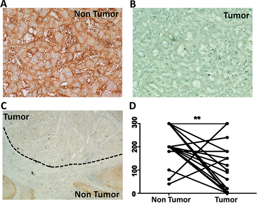 Figure 6 Expression of organic cation transporter-1 (OCT1) in human hepatocellular carcinoma and surrounding non-tumorous hepatocytes. The expression of OCT1 was confirmed using formalin-fixed, paraffin-embedded samples of 20 human HCC samples by immunohistochemistry using a standard protocol. Immunohistochemical staining of OCT1 was evaluated by two independent pathologists (Dr. Moroz and Dr. Wu), who scored staining pattern as 0 having no staining at all, 1 with weak staining, 2 with medium staining, and 3 with strong staining. By multiplying the intensity of score and the proportion of positive cells (0–100%), a semi-quantitative score ranging from 0–300 was calculated. (A). Show OCT1 expression in non-tumorous hepatocytes in the cirrhotic liver (Case number 16, magnification of 40X) (B). Negative OCT1 expression in hepatocellular carcinomas (tumor) (C). Low magnification images (4X, case number 16) showing expression of OCT1 in non-tumorous hepatocytes and HCC tumors show negative OCT1 expression. (D). The staining scores for OCT1 are significantly lower in HCC tissues than the corresponding non-tumorous liver (**p<0.0022).
