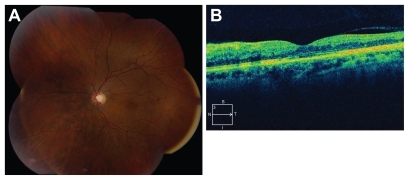 Figure 3 Recent follow-up. Best corrected visual acuity 20/25. (A) Color fundus photograph demonstrates resolution of majority of confluent hemorrhages. (B) Optical coherence tomography demonstrates resolved fluid (central foveal thickness 261 microns) and presence of subfoveal inner and outer segment disruption.
