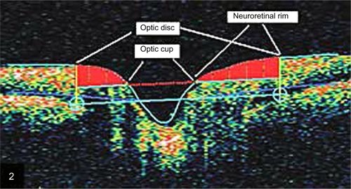 Figure 2 An example of the graphic output of the fast optic disc algorithm showing the optic cup area dimensions, optic disc, and neuroretinal rim. Five parameters are derived from this scan: rim area, average nerve width at disc, disc diameter, cup diameter, and rim length.