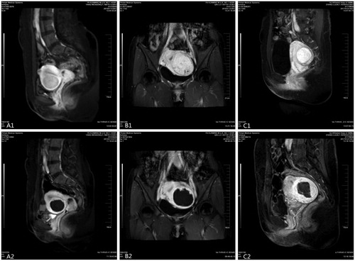 Figure 1. Contrast enhanced magnetic resonance imaging (CE-MRI) before and after treatment: (A1) anterior wall and mildly enhanced uterine fibroids; (B1) lateral wall and moderately enhanced uterine fibroids; (C1) posterior wall and significantly enhanced uterine fibroids; CE-MRI after treatment shows that the ablation area is not enhanced (A2, B2 and C2).