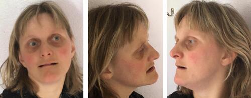 Figure 1 Clinical photographs of the patient at age 32 years showing mild facial dysmorphic features including divergent strabismus left eye, thin lips, small alae nasi, full nasal tip, short philtrum, pointed chin, and slightly upslanted palpebral fissures (right>left).