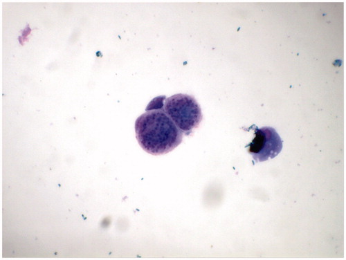 Figure 2. Subretinal aspirate (case 1) showing structures consistent with Toxoplasma gondii cysts with numerous bradyzoites, and a pigment-laden macrophage (May-Grumwald Giemsa, ×1000).