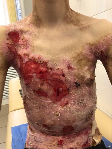 Figure 3 Appearance of lesions on the patient’s chest and abdomen on presentation.